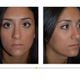 Illustration for article titled Nose Reshaping/Rhinoplasty em/em